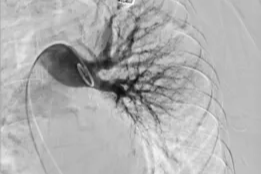 耄耋老人胸闷十年难愈？罕见病遇上肺动脉支架，终获新生……