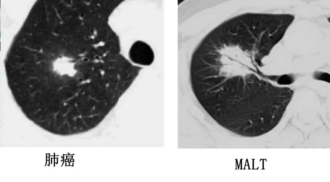【高尚病例】PET-CT 肺部疑难病例一例分享