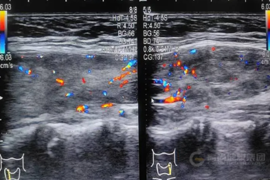 【超声病例】关注儿童健康—小心甲亢来敲门