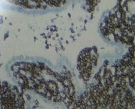 【高尚病例】PET-CT 肺部疑难病例一例分享