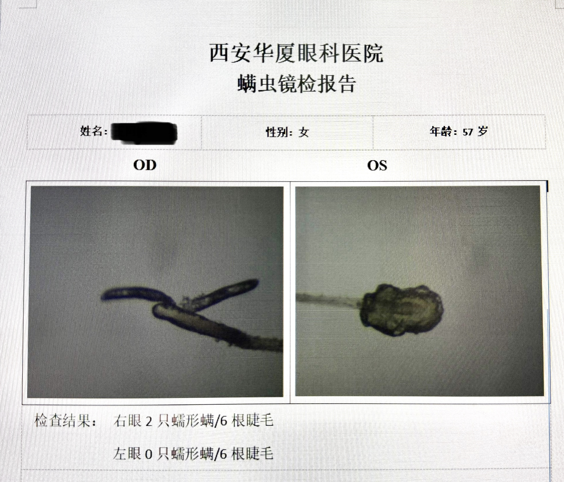 眼部蠕形螨感染治疗：坚持规范治疗的核心必要性与防止复发的科学依据