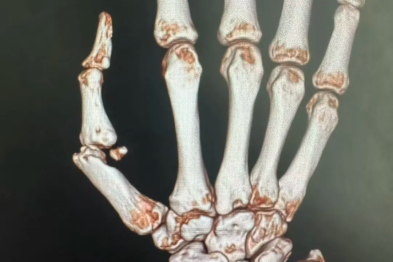 从接手指到「变形金刚」手指