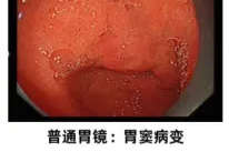 胃癌关爱日 | 有家族史的朋友，这事儿别马虎