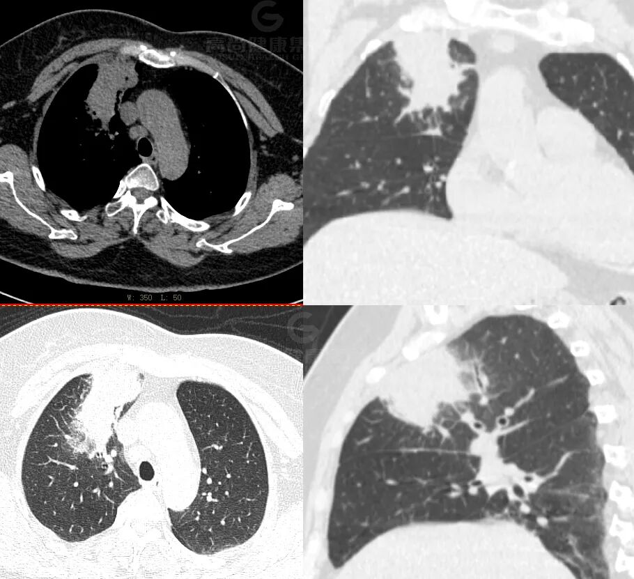 【高尚病例】肺曲霉菌病——「塔宾曲霉」