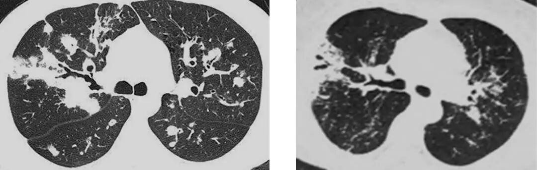 【高尚病例】PET-CT 肺部疑难病例一例分享