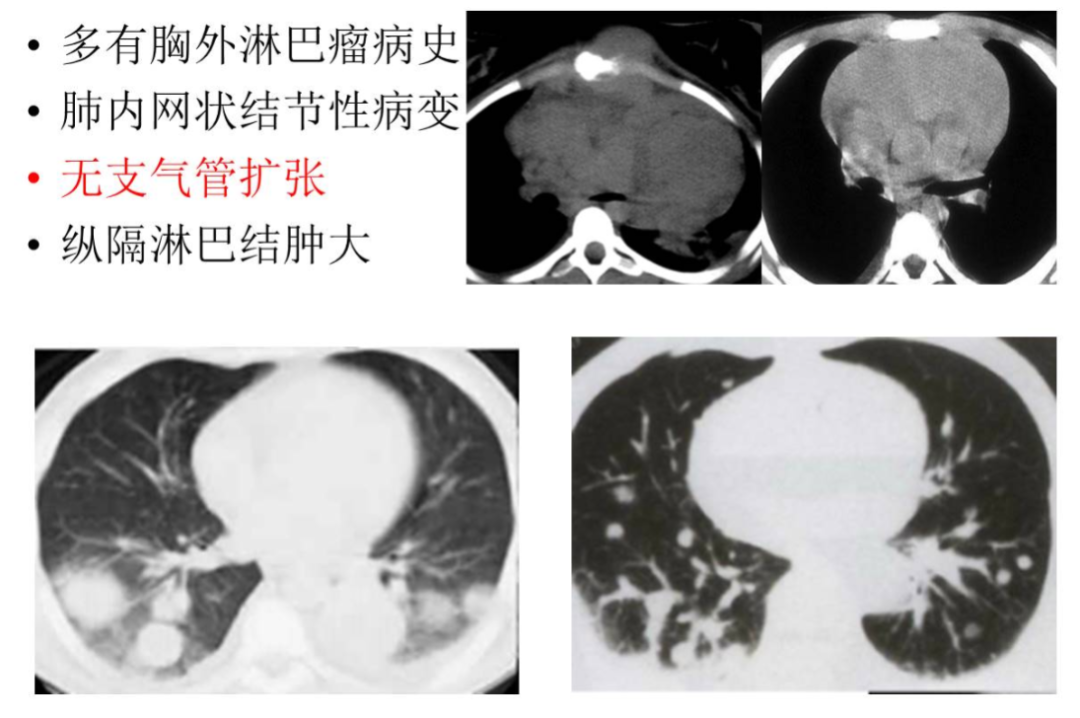 【高尚病例】PET-CT 肺部疑难病例一例分享