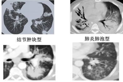 【高尚病例】PET-CT 肺部疑难病例一例分享