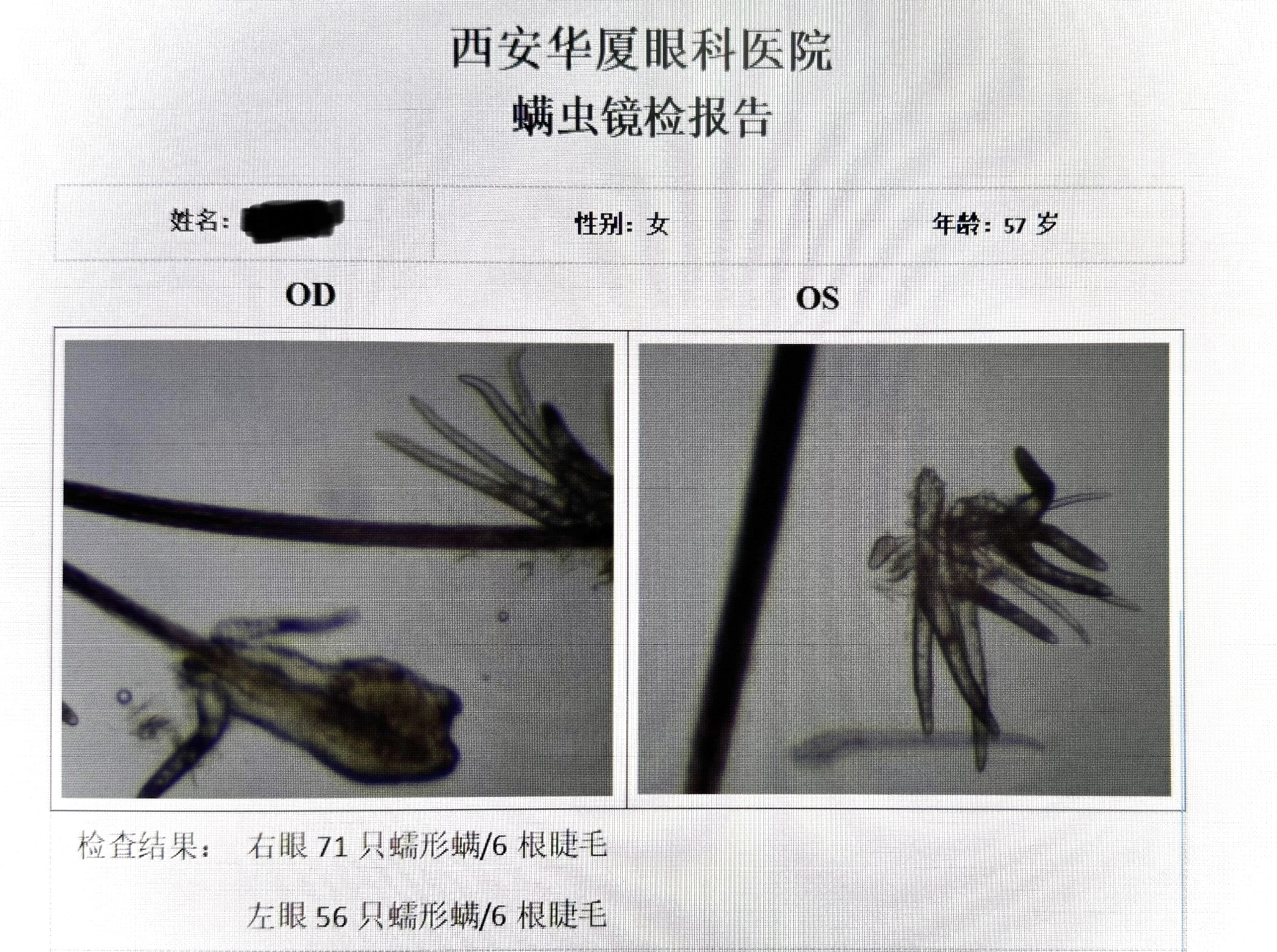 眼部蠕形螨感染治疗：坚持规范治疗的核心必要性与防止复发的科学依据