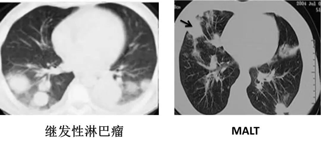 【高尚病例】PET-CT 肺部疑难病例一例分享