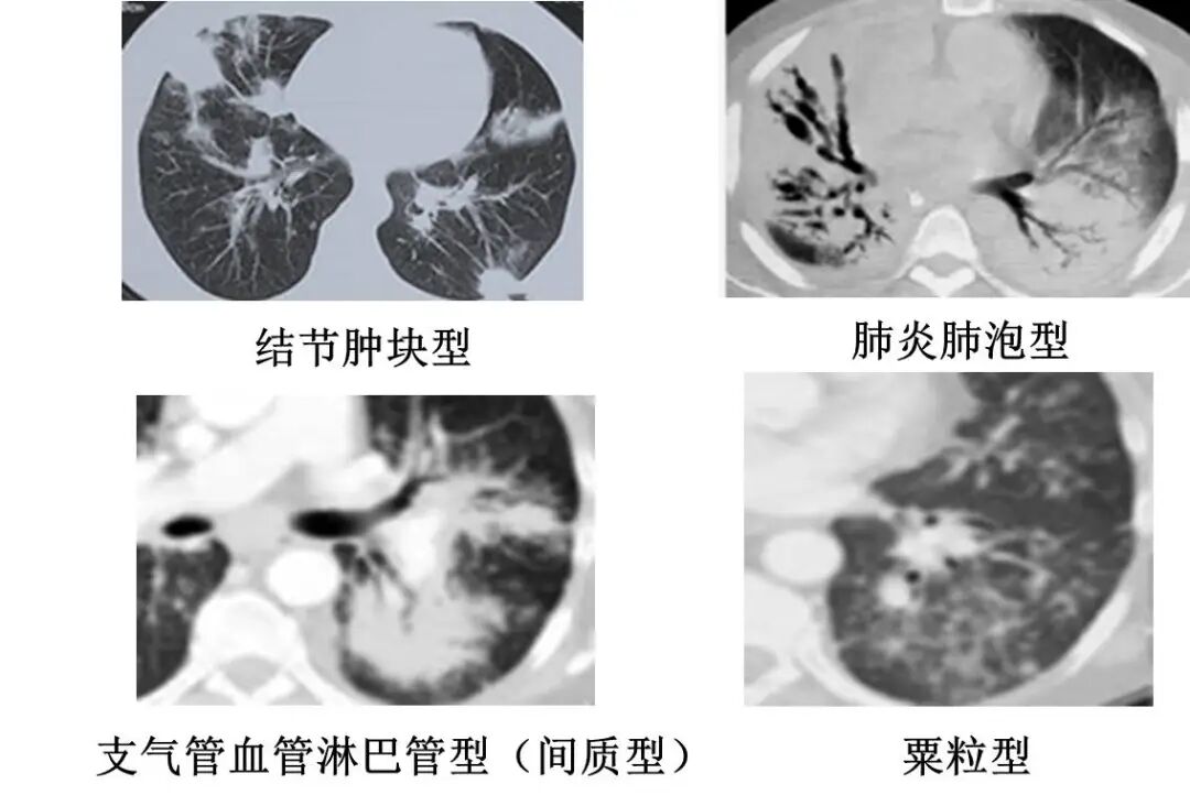 【高尚病例】PET-CT 肺部疑难病例一例分享