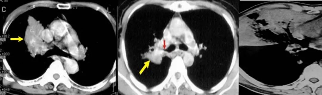 【高尚病例】PET-CT 肺部疑难病例一例分享