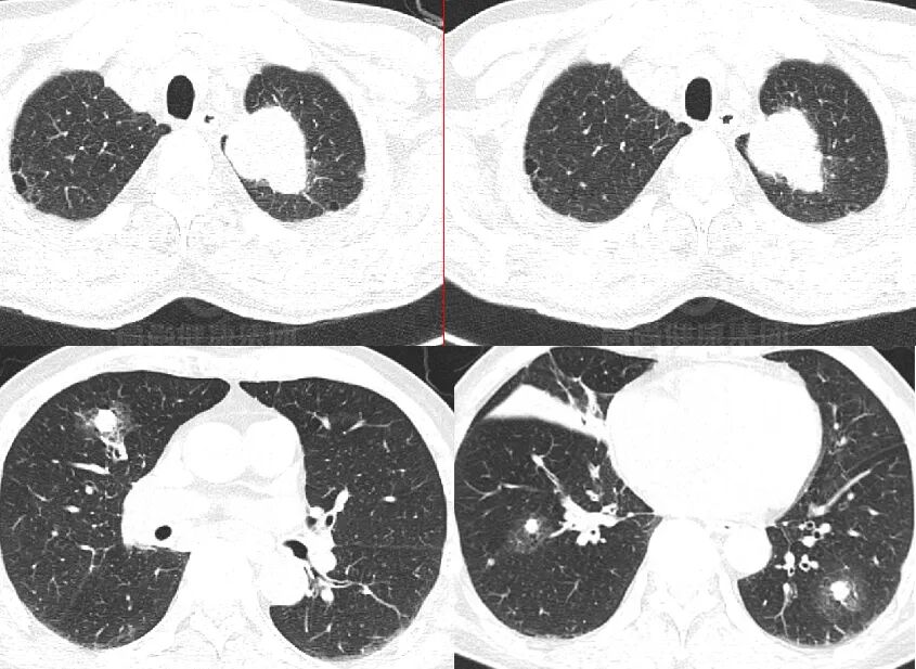 【高尚病例】肺曲霉菌病——「塔宾曲霉」