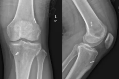 告别漫长恢复期，远离二次损伤 | 「全内」微创重建术，助您稳稳迈出第一步