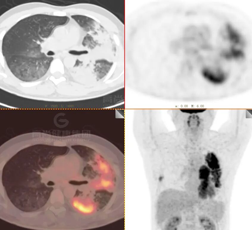 【高尚病例】肺曲霉菌病——「塔宾曲霉」