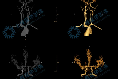 早筛警报！无症状的她，一次检查揪出两大「脑内炸弹」