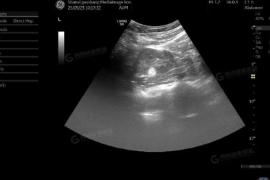 【高尚病例】肾错构瘤一例