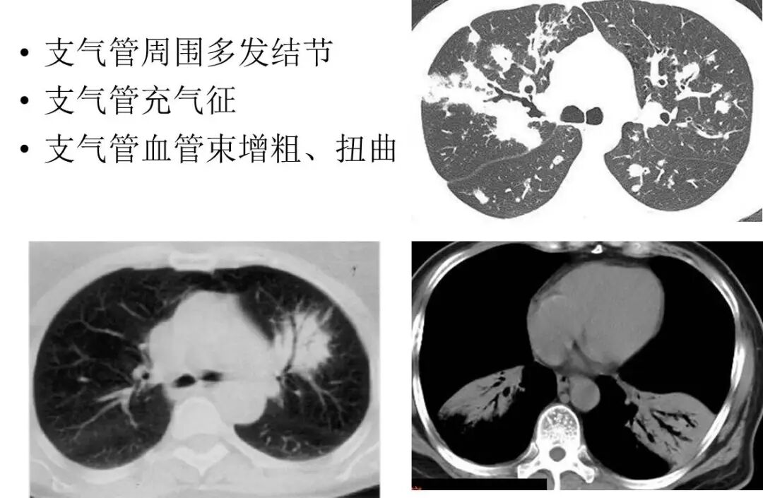 【高尚病例】PET-CT 肺部疑难病例一例分享