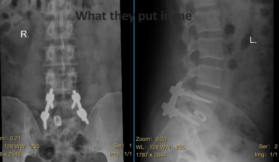 后路腰椎椎间融合术治疗 L5-S1 退变性疾病:手术要点与早期疗效观察