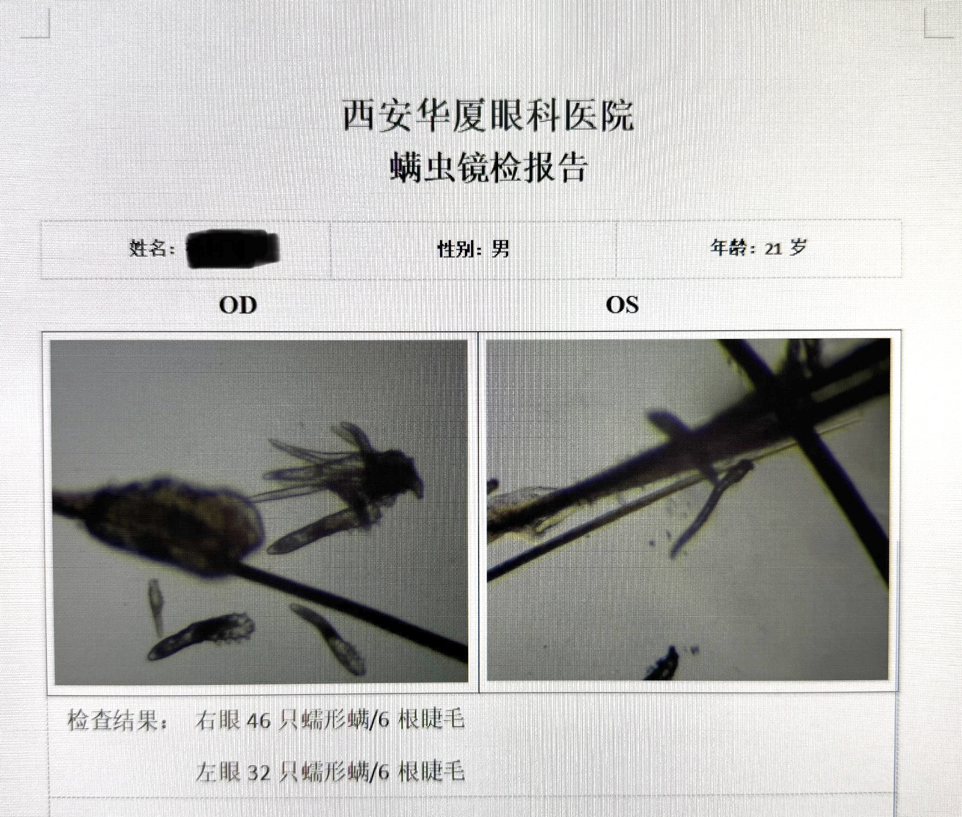 眼部蠕形螨感染治疗：坚持规范治疗的核心必要性与防止复发的科学依据