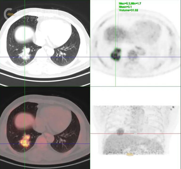 【高尚病例】PET-CT 肺部疑难病例一例分享