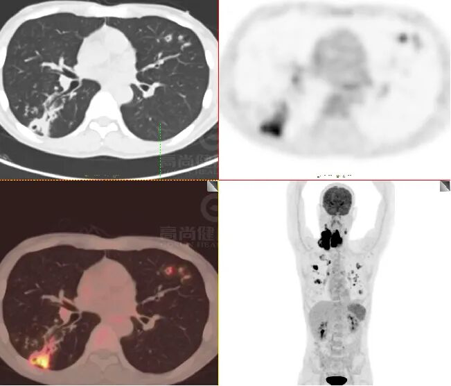 【高尚病例】肺曲霉菌病——「塔宾曲霉」