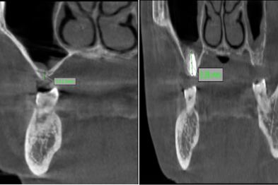 【传承中医智慧 融合现代科技】我院口腔团队突破骨量困境，让「失牙归位」！