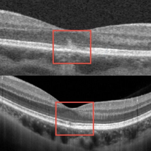 网红美容仪成「视力刺客」？医生提醒：这个操作 1 秒都不行