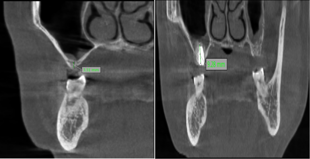 【传承中医智慧 融合现代科技】我院口腔团队突破骨量困境,让「失牙归位」!