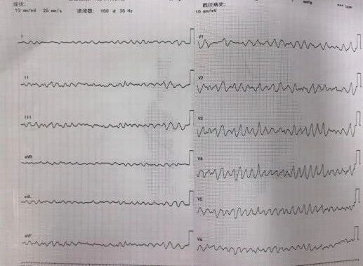 心脏停跳 66 小时！14 天接力救治！ICU 团队与死神博弈，暴发性心肌炎致持续室颤电风暴患者重启「心」生