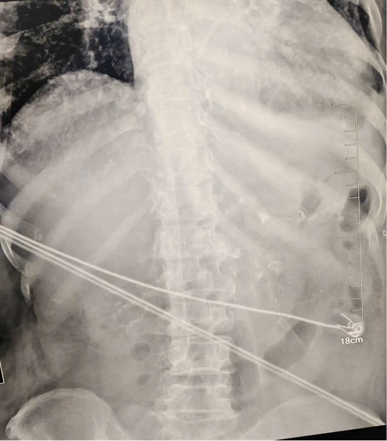 技术突破,精准护航 | 河科大二附院首例下肢 PICC 深静脉置管术成功实施!