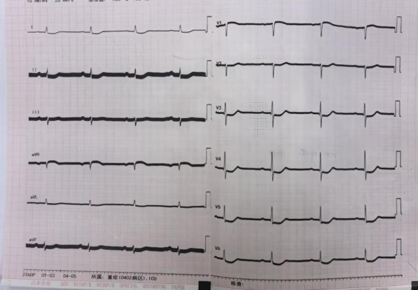 心脏停跳 66 小时！14 天接力救治！ICU 团队与死神博弈，暴发性心肌炎致持续室颤电风暴患者重启「心」生