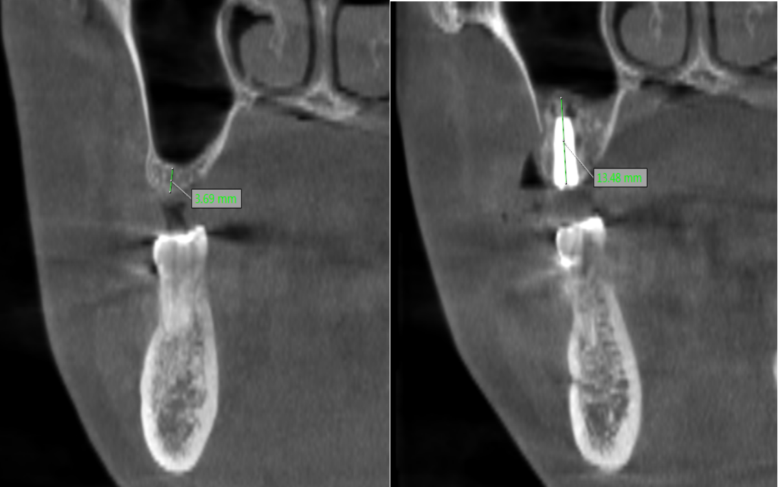 【传承中医智慧 融合现代科技】我院口腔团队突破骨量困境,让「失牙归位」!