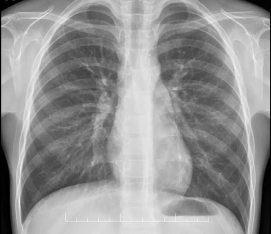 经常被忽略,发现就严重 ——「隐秘」的纵隔肿瘤