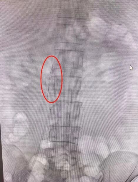 心脏停跳 66 小时！14 天接力救治！ICU 团队与死神博弈，暴发性心肌炎致持续室颤电风暴患者重启「心」生