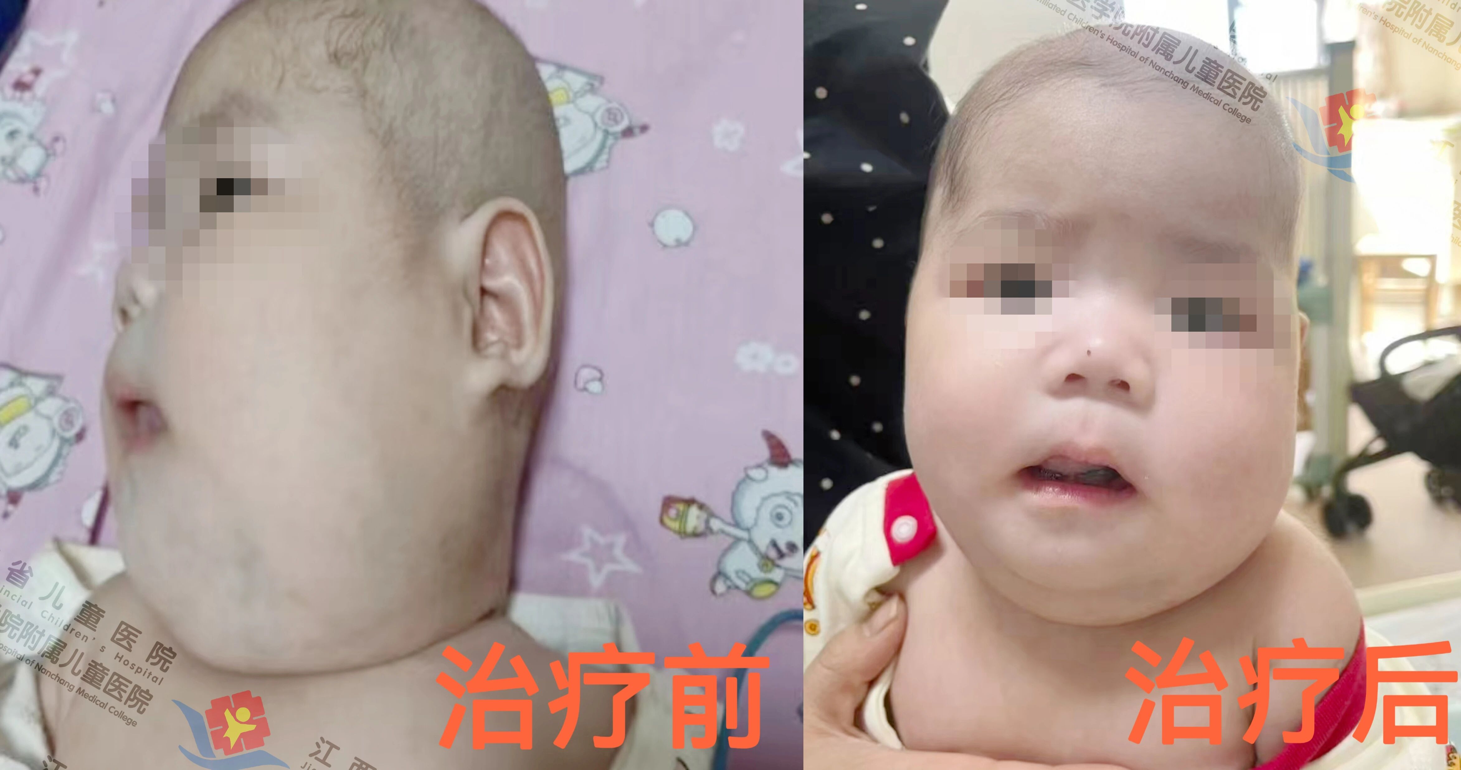 多学科诊疗再发力：联合疗法救治复杂淋巴管瘤患儿