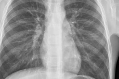 经常被忽略，发现就严重  ——「隐秘」的纵隔肿瘤