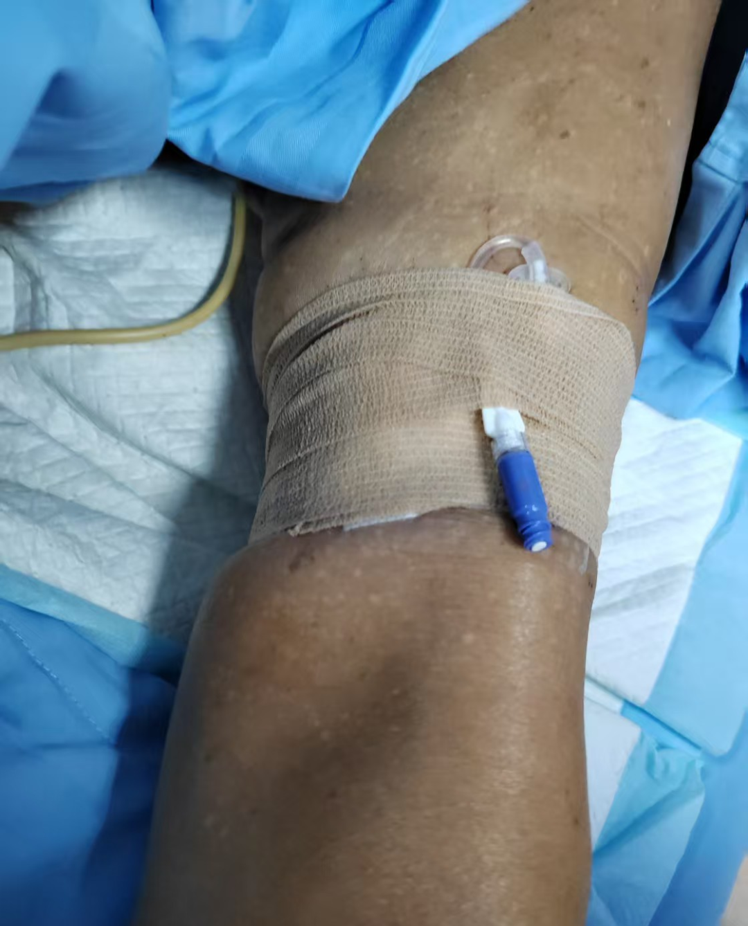 技术突破,精准护航 | 河科大二附院首例下肢 PICC 深静脉置管术成功实施!