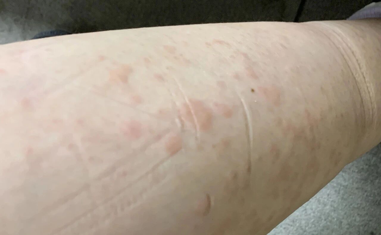 「光腿神器」怎么就成了「美丽刑具」?爱美的女士请注意