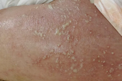 全身脓疱高烧！紧急提醒：这种百万分之一的病，早期像普通过敏！