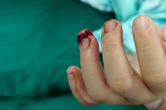 多图警示！一个动作，酿成大祸！3 岁女童手指夹伤坏死被截肢！