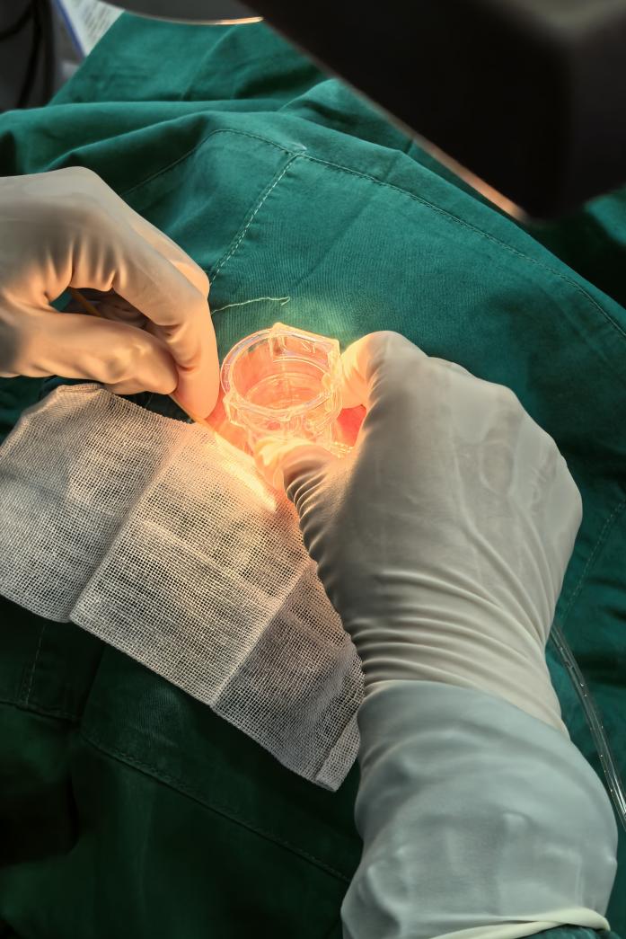 绝对期青光眼剧痛难忍,UCP 无创技术带来新希望