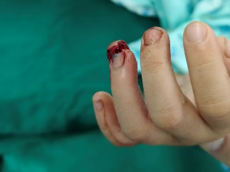 多图警示!一个动作,酿成大祸!3 岁女童手指夹伤坏死被截肢!