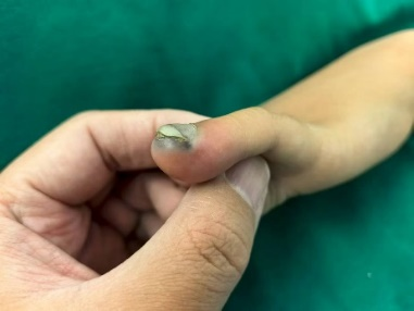 多图警示!一个动作,酿成大祸!3 岁女童手指夹伤坏死被截肢!