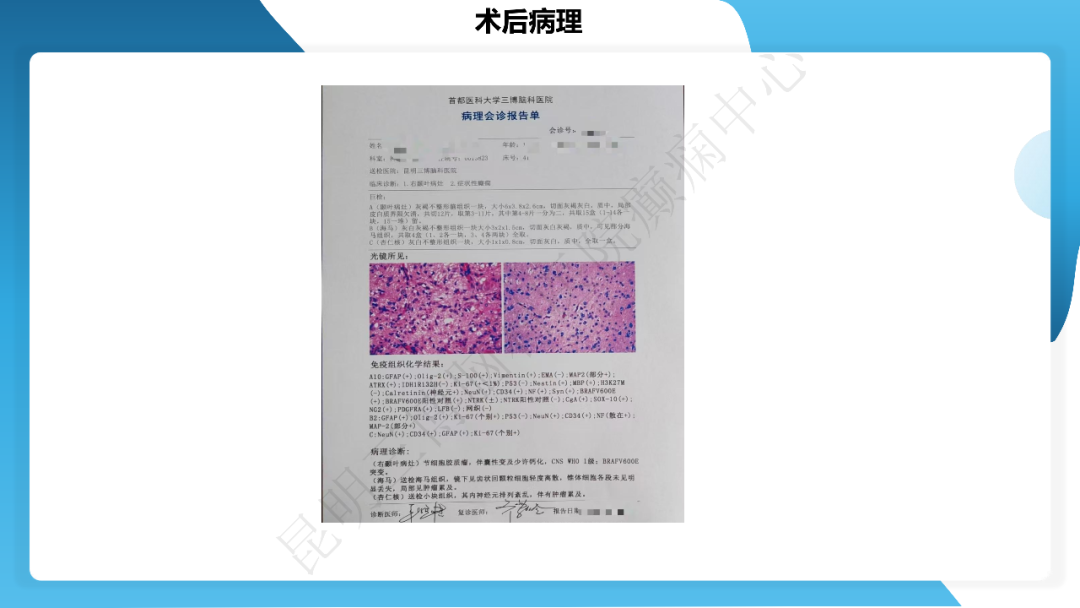 《「痫停」信步》癫痫治疗病例荟萃第四十期---手术治疗节细胞胶质瘤继发癫痫 1 例