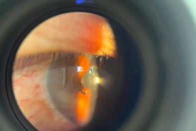 铁丝扎入眼球，两院急诊联动「保住视力」