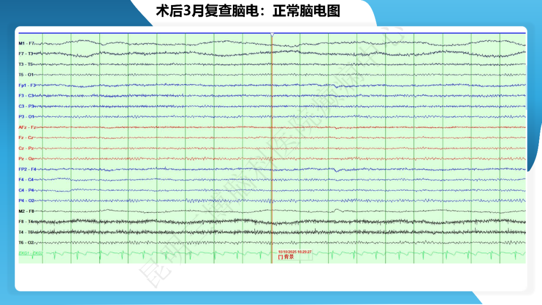 《「痫停」信步》癫痫治疗病例荟萃第三十九期---激光微创治疗海马硬化继发难治性癫痫一例