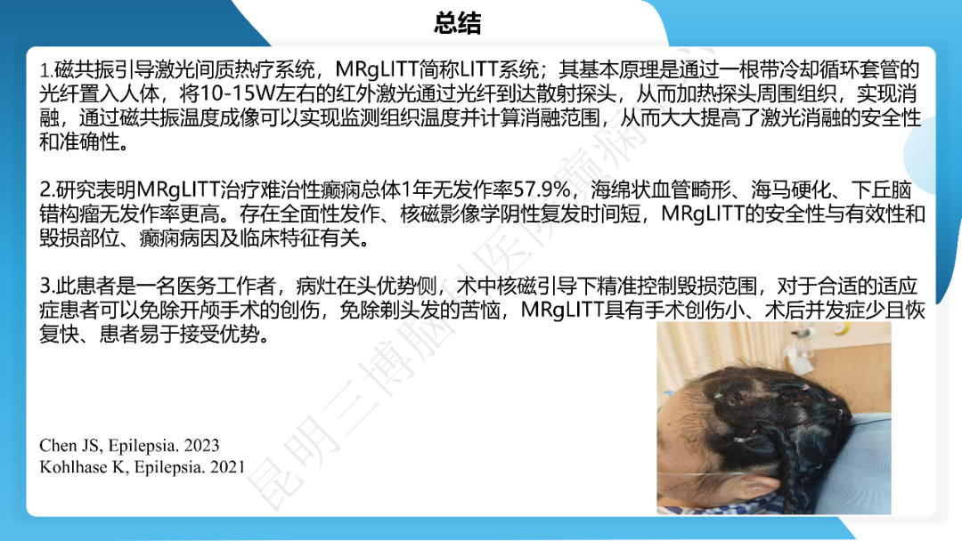 《「痫停」信步》癫痫治疗病例荟萃第三十九期---激光微创治疗海马硬化继发难治性癫痫一例