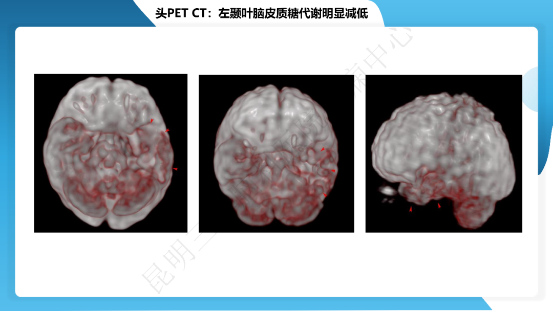 《「痫停」信步》癫痫治疗病例荟萃第三十九期---激光微创治疗海马硬化继发难治性癫痫一例
