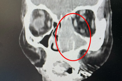 眼睛流泪，元凶在鼻子，长期鼻塞竟然是恶性肿瘤，仁品专家：「早期诊断、规范治疗还有救！」