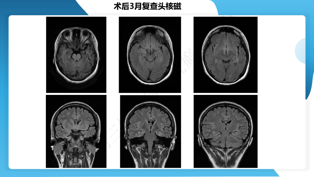 《「痫停」信步》癫痫治疗病例荟萃第三十九期---激光微创治疗海马硬化继发难治性癫痫一例